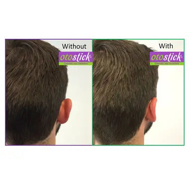 Otostick Estetico Orecchio Concealer per pelli normali
