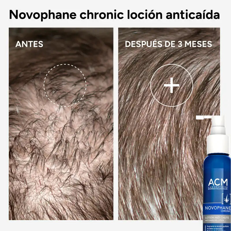 Acm Laboratoires Novophane Lozione anticaduta cronica, 100 ml