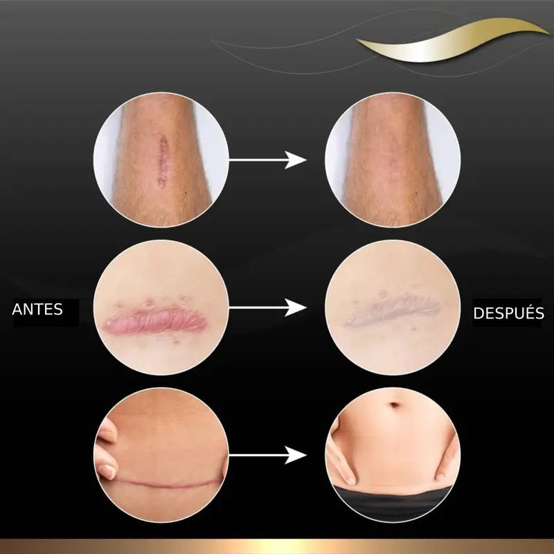 Dermatix Gel di silicone per il trattamento delle cicatrici, 15 g