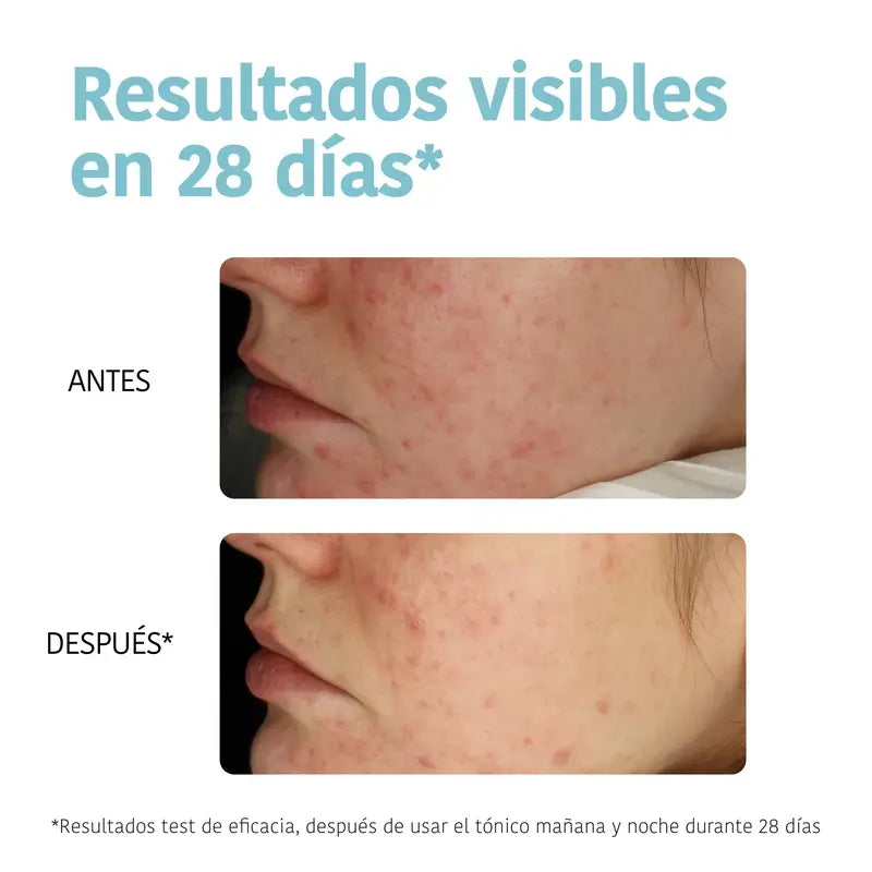 Iroha Nature Dischetti tonificanti anti-imperfezioni per pelle grassa, 50 pezzi.