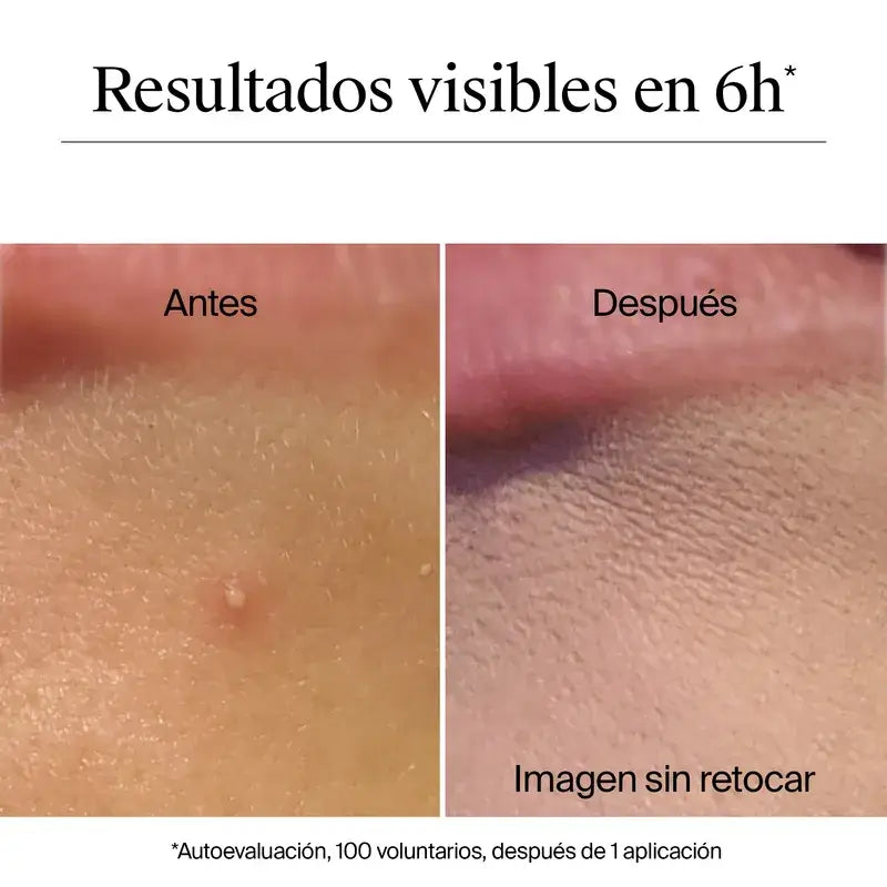 Neutrogena Clear & Defend+ Cerotti idrocolloidi anti acne 30